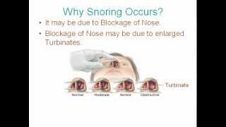 Health Videos Best Treatment for Snoring  Nasal blockage  Coblation Turbinoplasty [upl. by Zanahs]