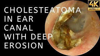 Cholesteatoma In Ear Canal With Deep Erosion 4K 60FPS [upl. by Joseito]