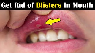 How to Get Rid of Blisters in Mouth fast  8 Home Remedies for Blisters in Mouth and Tongue [upl. by Teeniv]