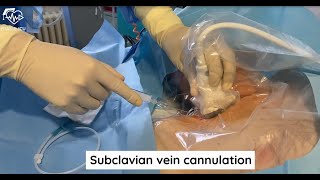 Subclavian vein cannulation [upl. by Nylkcaj380]