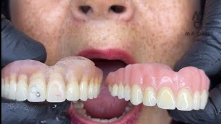 PRÓTESIS DENTAL FLEXIBLE O ACRILICA  🤔🤔 viral odontologia fypシ [upl. by Luise]