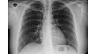 Chest xray  Asbestosis  Pleural calcifications  Round atelectasis [upl. by Sagerman]