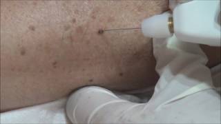 Angioma Removal with Plexr [upl. by Aleen]