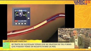 Entrevista sobre varices en La7Tv Murcia agosto2020 [upl. by Synn]