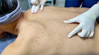 ACNE TREATMENT VU QUYNH MI Blackheads On Boy Back 2024 [upl. by Caputo]