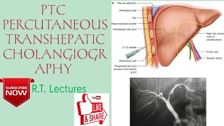 PTCPTHC PERCUTANEOUS TRANSHEPATIC CHOLANGIOGRAPHY Procedure HindiEnglish for BRT amp DRT students🥰 [upl. by Garrity]