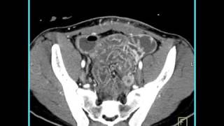 Abdomen Small Bowel EnteritisSeries of coronal sagittal volume rendered and MIP images4 of 6 [upl. by Drofhsa547]