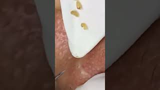 Magnified views of a pimple extraction satisfyingvideo skincareroutine pimple acne viralshort [upl. by Ihp]