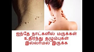 ஐந்து நாட்களில் மருக்கள் உதிர  REMOVE SKIN TAG IN TAMIL LANGUAGE [upl. by Nagiam755]