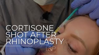 Cortisone Shot after Rhinoplasty [upl. by Zulema486]