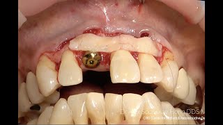 Postextraction implant nach Zucchelli Mucogingival Approach in maxillary esthetic zone Dr Alex Hong [upl. by Barraza]