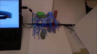 IRCAD  Visible Patient  Hololens AR Visualisation of patient [upl. by Adnale]