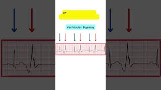 Premature Ventricular Contractions ecg medicine doctor cardiology medicalstudent medschool [upl. by Fanya]