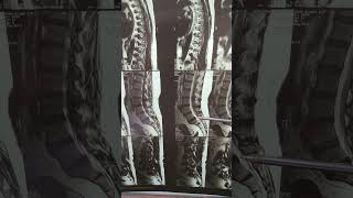 Lumbar SpondylosisMRI [upl. by Ransell]