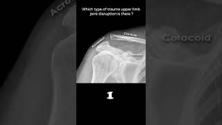 Acromioclavicular joint disruption 61 Trauma Xray Upper limb radiologychannel007 [upl. by Gaddi]