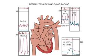 Right Heart Catheterization  an introduction [upl. by Voe]