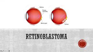 Retinoblastoma  A Clinical Overview for Medical Students [upl. by Marchak656]