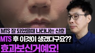 【MTS 효과를 본 증거】 mts 효과나게 하는 방법 3가지 [upl. by Ai]