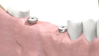 SIC invent Dental Implant  Prosthetic Animation BridgeWork Open Tray Technique [upl. by Yatzeck]