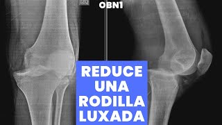 RODILLA LUXADA O DISLOCADA  APRENDE A REDUCIRLA [upl. by Ogram]