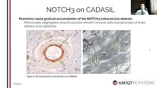 CADASIL  Stroke and Vascular Dementia in adults by Ricardo Carrillo Meza [upl. by Anairol]