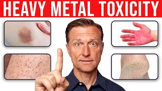 4 Skin Signs That Reveal Heavy Metal Toxicity [upl. by Cuda]