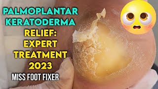 Palmoplantar Keratoderma Relief Expert Treatment for Thick Callus Removal by miss foot fixer [upl. by Dolli]