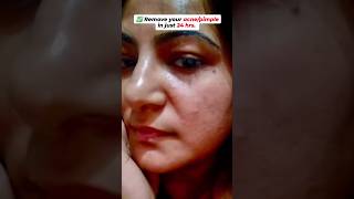 ⭕Remove Your AcnePimple in Just 24Hrs 😱 pimple acne skincare simranskincare [upl. by Lyrrehs253]