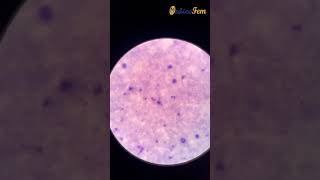 Plasmodium vivax Malaria Smear Examination  Giemsa Stain  Thick  Thin Peripheral Blood Smear [upl. by Htenywg]