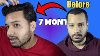 7 Month Update  Hair Transplant [upl. by Akehs]