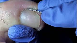 DIY Ingrown Toenail Removal  How to Safely Cut Ingrown Toenails at Home [upl. by Kattie385]