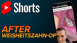 Nach Weisheitszahnentfernung shorts [upl. by Ettenahs417]