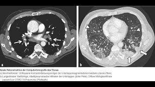 Lungenarterienembolie bei COVID19 trotz Thromboseprophylaxe [upl. by Lisetta705]