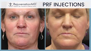 PRF Under Eye Injections [upl. by Nolham]