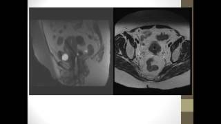 ACRO Webinar  3D Imagebased Brachytherapy for Cervical Cancer [upl. by Eanahs]