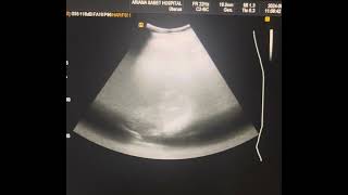 Liver hydatid daughter cyst [upl. by Yssac]