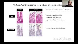 Ischémie mésentérique  Simon BOURCIER [upl. by Safoelc981]