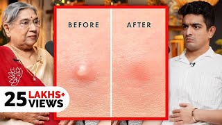 Fastest Pimple Healing Exercise amp Hacks Explained  Yoga For Clear Skin [upl. by Koressa]