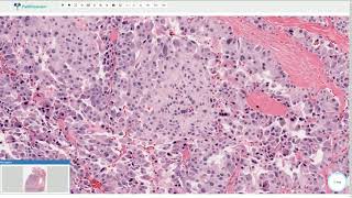 Medullary Carcinoma  Thyroid Gland Histopathology [upl. by Irahk]