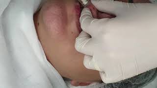 Técnica de preenchimento labial com Intradermoterapia Pressurizada [upl. by Yalahs771]