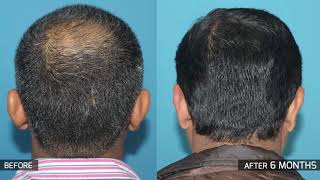 Crown hair transplant in India  Eugenix Hair Transplant Sciences [upl. by Namara]