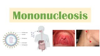 Infectious Mononucleosis Mono  EpsteinBarr Virus Transmission Symptoms Diagnosis Treatment [upl. by Ahse184]