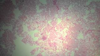 P16 esteatosis hepatica [upl. by Rawden296]