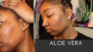 I Used Aloe Vera on my Face for 5 Days It RUINED my face  MUST WATCH [upl. by Nitreb]