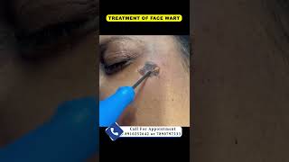 Treatment of face wart  By Dr Uttam Kumar Lenka MBBS MD Consultant Dermatologist [upl. by Atiram266]