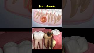 Tooth abscess problem dentist dentisty teeth dental [upl. by Otreblide]