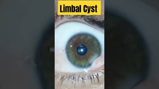 Limbal Cyst  Optometry With Shahid [upl. by Etnahc235]