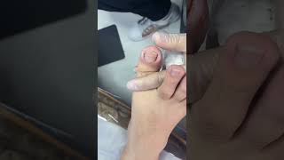 Ingrown toenail removal with Pedicure Knife Cut it easily Ep440 [upl. by Cami923]