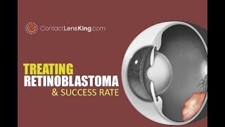 Retinoblastoma Treatment and Eye Cancer Survival Rate [upl. by Jinny]