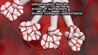 Pulmonary Embolism narration and animation by Cal Shipley MD [upl. by Meara]